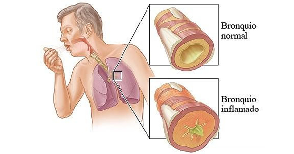 ¿CÓMO AFECTA LA BRONQUITIS EN LA EDAD ADULTA? 1bronquitis