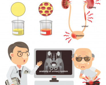 HEMATURIA: ¿QUÉ ES Y CUÁNDO PREOCUPARSE?